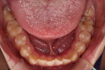 舌小帯は伸ばせる こどもの舌小帯の基礎知識と家庭での対処法 手術について 武蔵浦和駅の歯医者 スカイ ガーデンデンタルオフィス