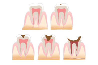 虫歯の経過