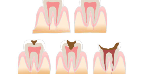 虫歯の経過