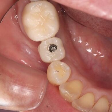 インプラントの人工歯=上部構造の取り付けについて。 | 武蔵浦和駅の歯医者 | スカイ＆ガーデンデンタルオフィス武蔵浦和駅の歯医者 |  スカイ＆ガーデンデンタルオフィス